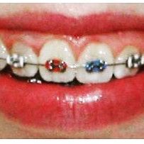 Braces San Clemente, CA